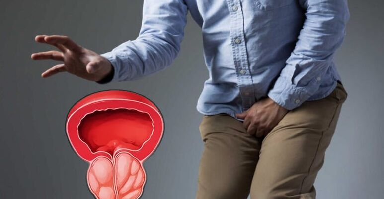Prevencia prostatitídy a adenómu prostaty