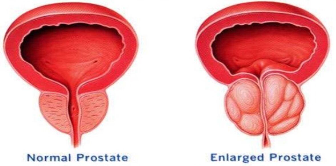 Normálna prostata, zapálená prostata